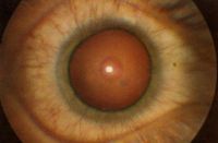 Тринитротолуоловая (ТНТ) катаракта. Начальная стадия; видно кольцо помутнения в центре хрусталика (ранний симптом общей интоксикации ТНТ).