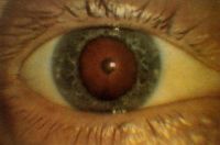 Тринитротолуоловая (ТНТ) катаракта. Кольцевое помутнение в центре и начальные помутнения по периферии.