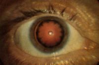 Тринитротолуоловая (ТНТ) катаракта. 