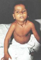 вид больного ребенка с дифтерией гортани