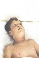 фото ребенка с токсической дифтерией зева