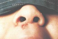 дифтерия носа