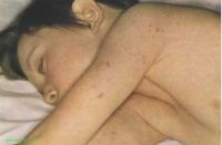 геморрагическая сыпь на теле у детей