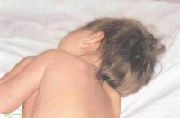 менингеальные знаки у детей при менингококковом менингите