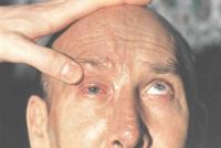 птоз, паралич глазодвигательных мышц при опоясывающем лишае
