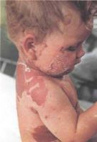 вид ребенка с синдромом ошпаренной кожи