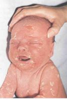 фото новорожденного с синдромом Риттера