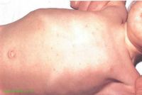 розеолёзная пятнисто-папулёзная сыпь у детей при паратифе