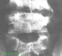 рентгенограмма: остеомиелит поясничных позвонков  - редкое осложнение брюшного тифа