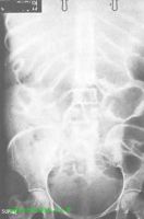 рентгенограмма: паралитическая кишечная непроходимость у больного брюшным тифом