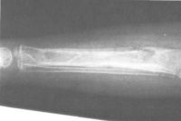 рентгенограмма: поражение костей голени при брюшном тифе