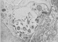 Нейтрофильный гранулоцит с гигантской фаголизосомой содержащей микобактерию туберкулёза