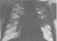 Хронический диссеминированный гематогенный туберкулёз легких