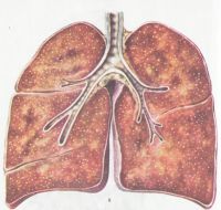 Острый диссеминированный (милиарный) туберкулёз легких