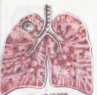 Паталогоанатомический препарат хронического гематогенного диссеминированного туберкулёза легких