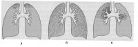 Виды туберкулёзных диссеминаций 