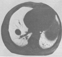 Аксиальная компьютерная томограмма органов грудной полости больного с туберкулёмой легкого