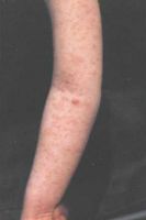 ветряная оспа и корь: на фото два вида сыпи у одного больного
