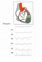 Стресс индуцированная ишемия в области рубца после перенесённого переднего инфаркта миокарда -1