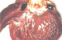 Тромбоз коронарной артерии