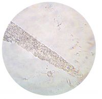 гиалиново-капельный цилиндр в моче больного хроническим гломерулонефритом