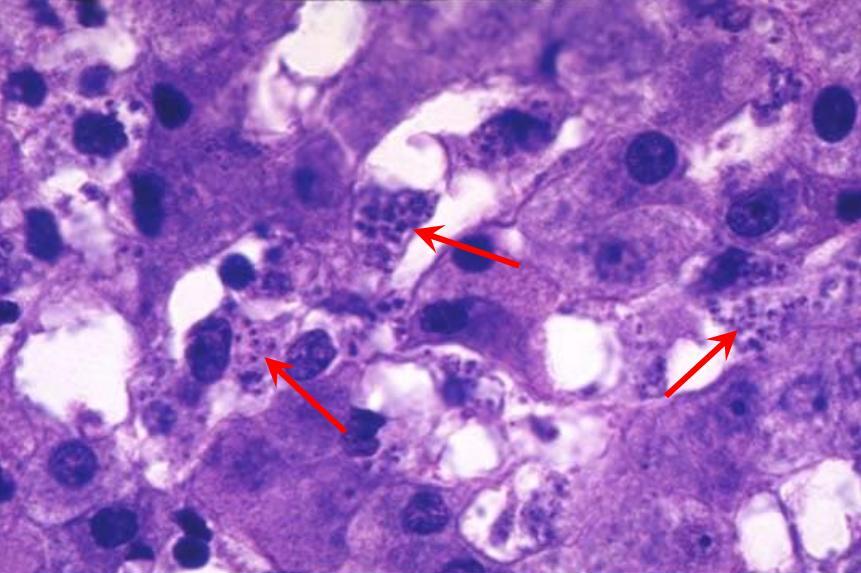 Лейшмании внутри макрофагов и эндотелиальных клеток в печеночных синусоидах