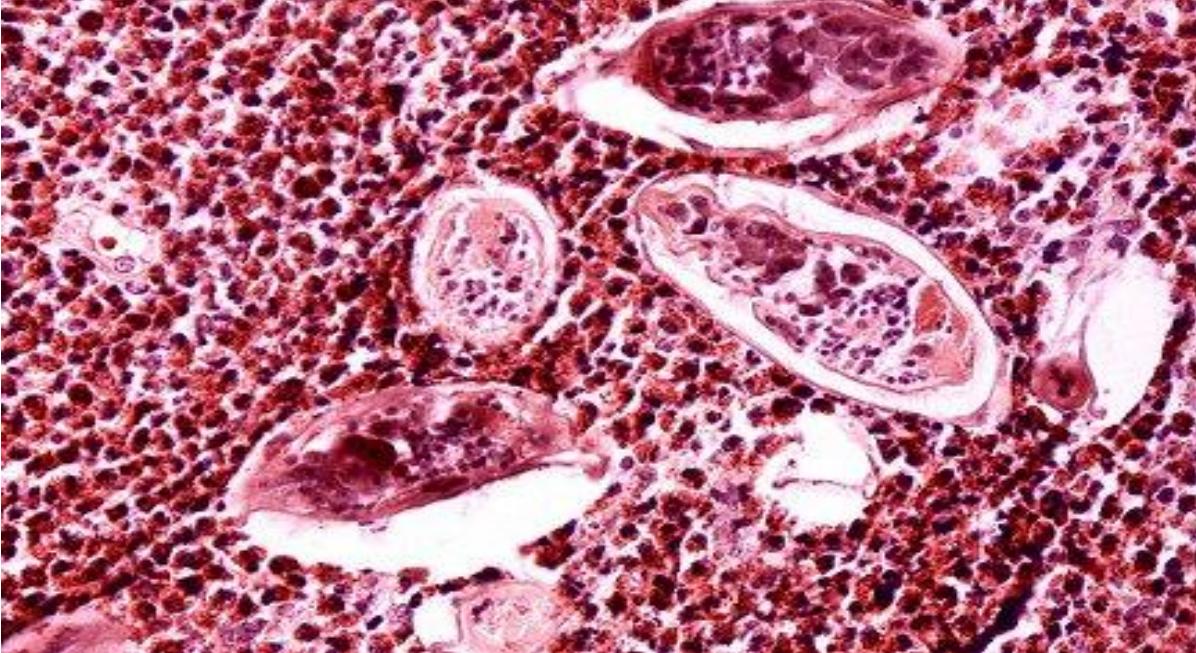 Яйца кровяной шистосомы в тканях, окруженные инфильтратами из нейтрофилов