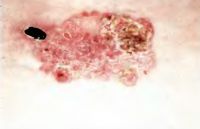 Болезнь Боуэна - гиперкератотическая бляшка местами покрыта корками