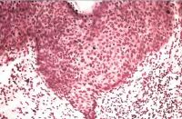 Эритроплазия Кейра - разрастание клеток шиповатого слоя с выраженным ядерным полиморфизмом.