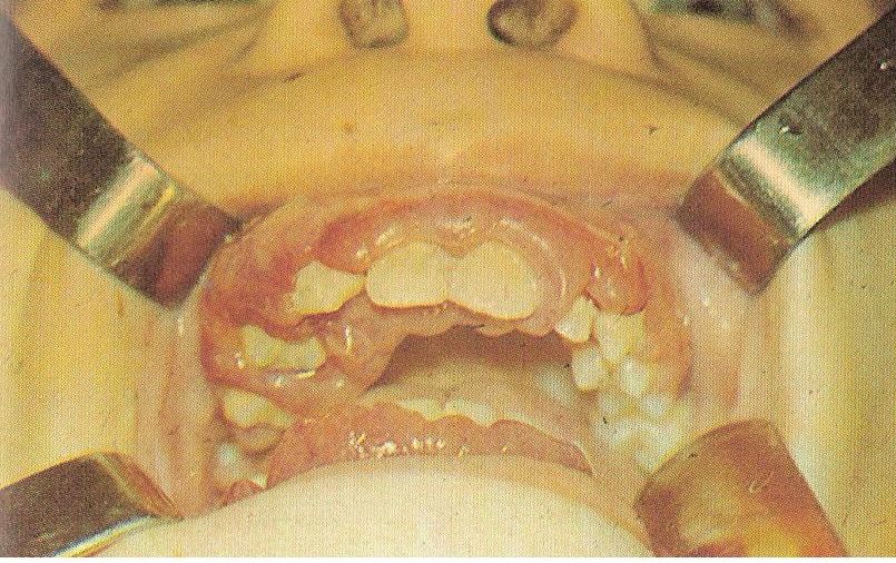 фиброматоз альвеолярных отростков верхней и нижней челюсти