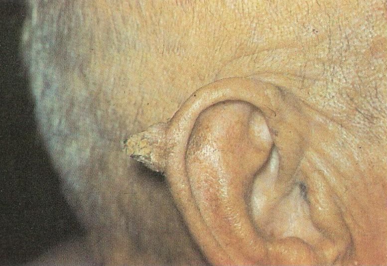 кожный рог ушной раковины