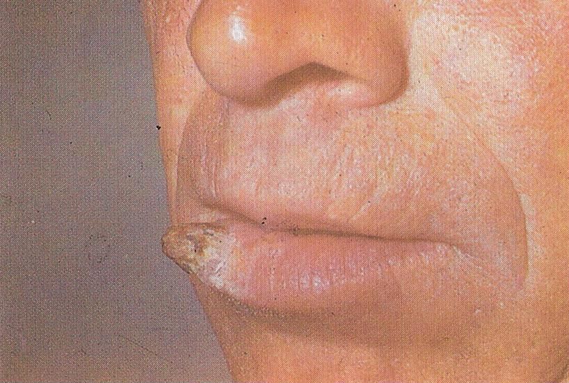 кожный рог боковой трети нижней губы