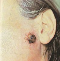 Меланома кожи лица в околоушно-жевательной области