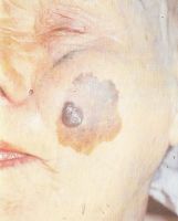 Меланома на фоне меланоза Дюбрея в щечной области