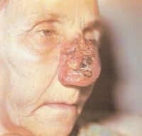 Поражение наружного носа инфильтрирующей формой плоскоклеточного рака кожи