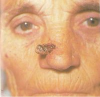 Папиллярная форма плоскоклеточного рака кожи в области крыла носа 
