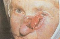 Инфильтрирующая(язвенная) форма рака кожи подглазничной области, боковой стенки носа 