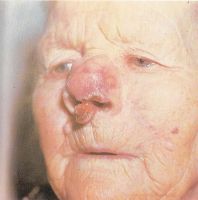 Инфильтрирующая форма рака кожи в области носовой перегородки и кончика носа 