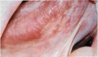 Плоскоклеточный рак языка