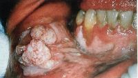 Бородавчатый рак на слизистой оболочке губы