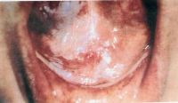 Плоскоклеточный рак дна полости рта