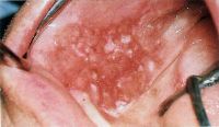 Эритролейкоплакия: плоскоклеточный рак полости рта