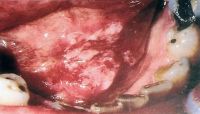 Пятнистая эритроплакия: плоскоклеточный рак
