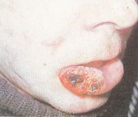 Папиллярная форма рака нижней губы (у больного с туберкулёзной волчанкой).