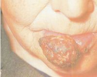 Еще одна больная с папиллярным раком губы в Т3 стадии