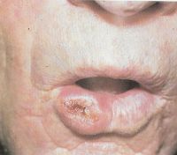 Язвенная форма рака нижней губы 