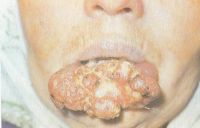 4 стадия распространенности рака губы. Сходная локализация и стадия что и на предыдущем фото