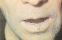  Ограниченный предраковый гиперкератоз красной каймы нижней губы 