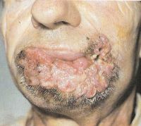 Обширная опухоль нижней губы, распространившаяся на мягкие ткани подбородочной и щечных областей, Т4
