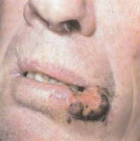 Опухоль в области боковой трети губы, Т3